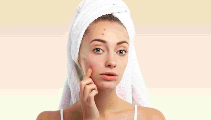 solusi-terbaik-untuk-kulit-bebas-jerawat-dengan-terapi-acne