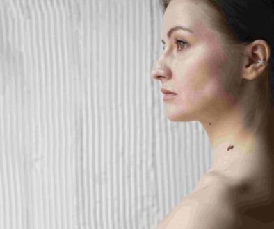 dark-spot-hilang-dengan-teknologi-canggih-di-lavalen-medica dark-spot-hilang-dengan-teknologi-canggih-di-lavalen-medica