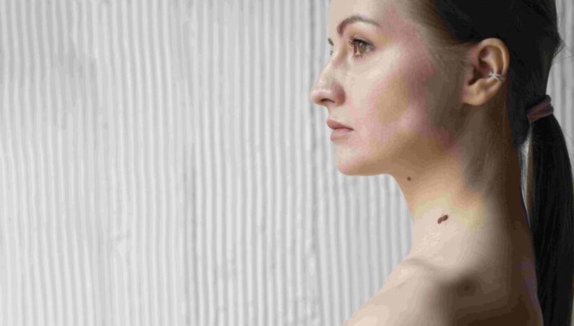 dark-spot-hilang-dengan-teknologi-canggih-di-lavalen-medica dark-spot-hilang-dengan-teknologi-canggih-di-lavalen-medica