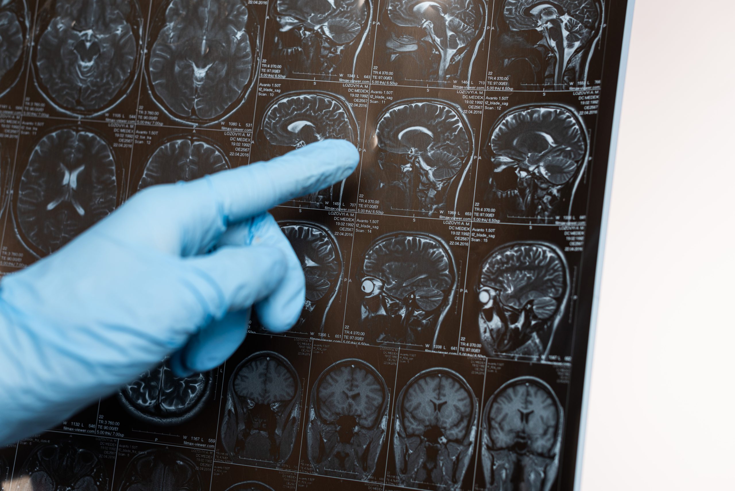 Stroke Usia Muda