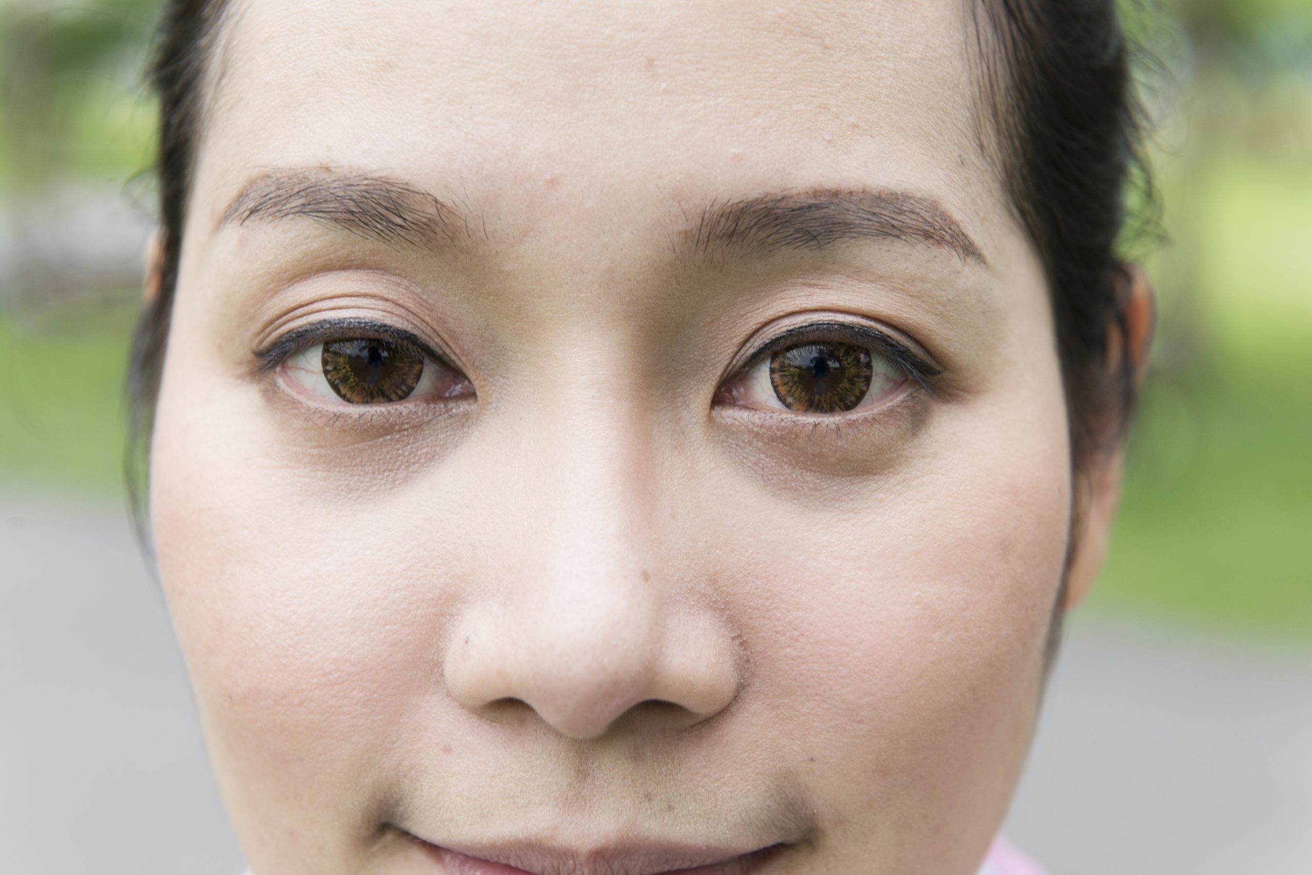 Ptosis