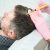 exosome hair treatment di lavalen medica