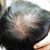 exosome untuk rambut