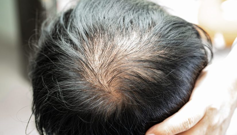 exosome untuk rambut