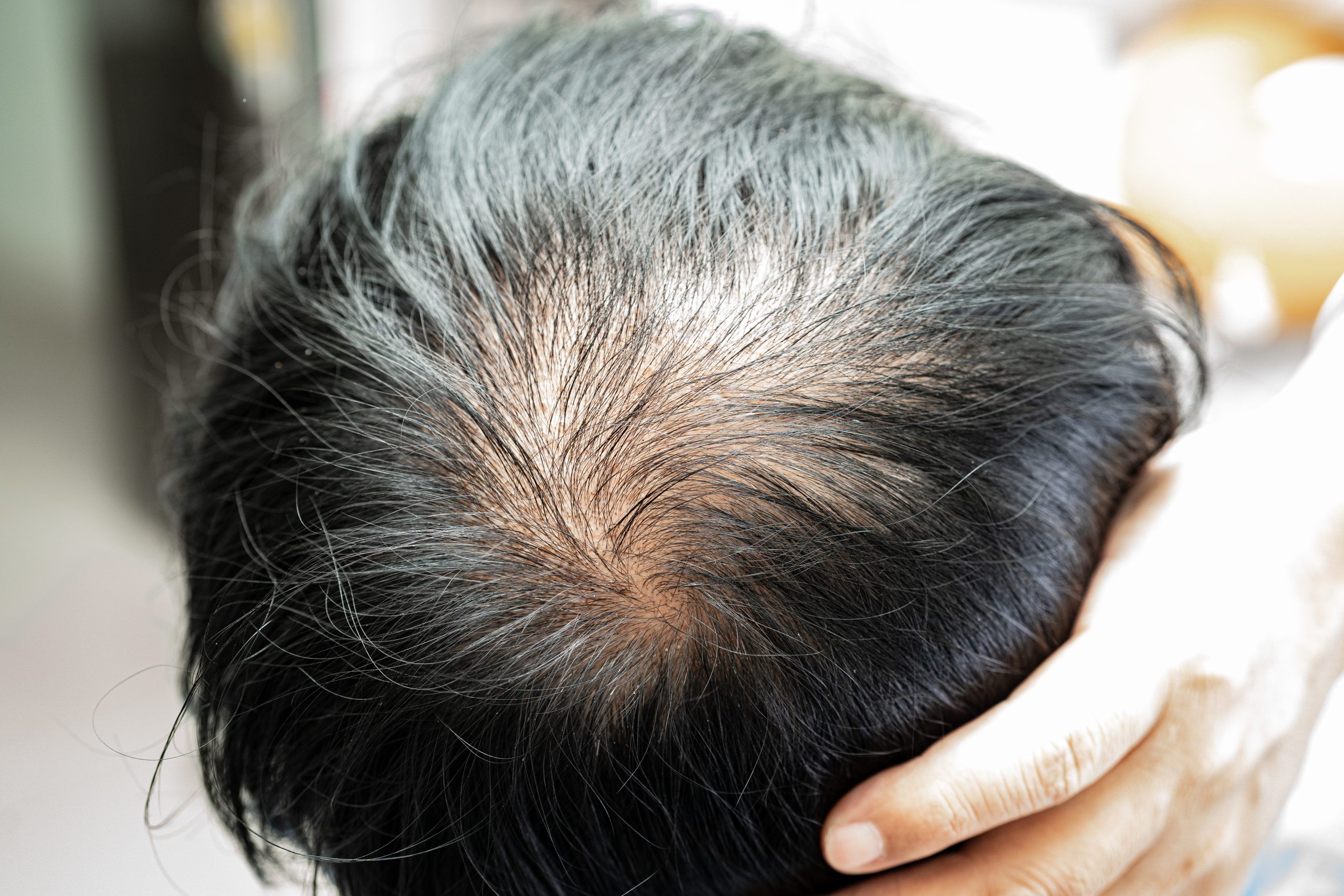 exosome untuk rambut