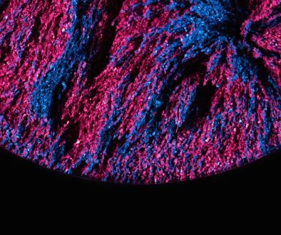 exosome vs filler