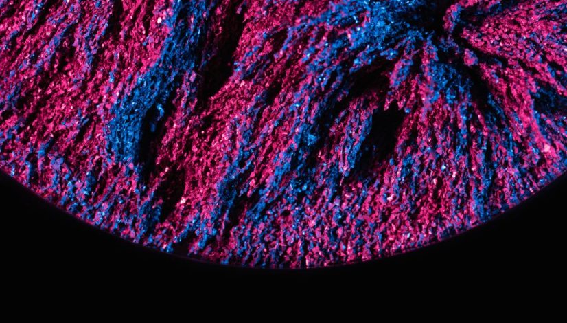 exosome vs filler